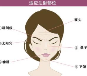 填充式注射除皱的果好不好？戳进来看看注射除皱的过程及原理吧