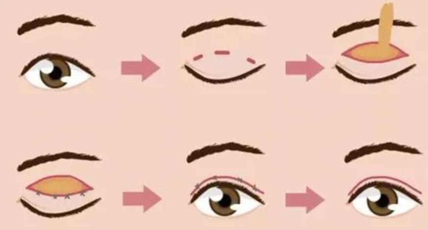 双眼皮dm15.jpg 双眼皮dm15.jpg