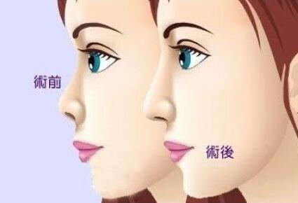 隆鼻动漫21.jpg