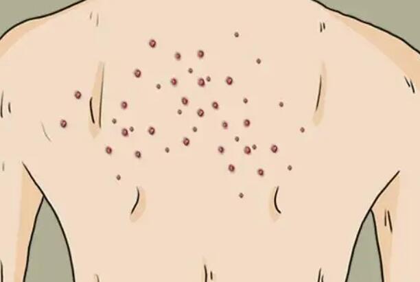 背上祛痘动漫02.jpg 背上祛痘动漫02.jpg