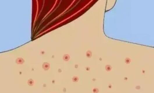 背上祛痘动漫.jpg 背上祛痘动漫.jpg