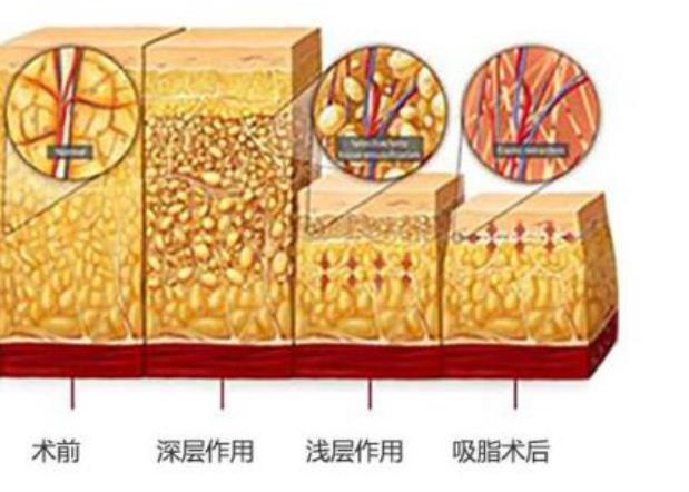 等离子激光溶脂果如何？溶脂的原理是什么？术后注意事项有哪些？