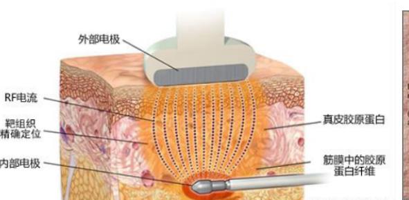 激光溶脂01.jpg