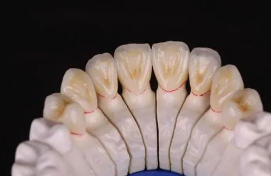 全瓷牙hg02.jpg 全瓷牙hg02.jpg