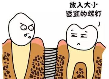 牙齿种植dm05.jpg 牙齿种植dm05.jpg