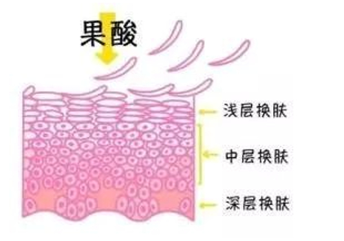 果酸治疗黄褐斑几次能治疗好？快来看详细科普介绍吧