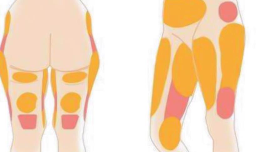 大腿吸脂dm02.jpg 大腿吸脂dm02.jpg