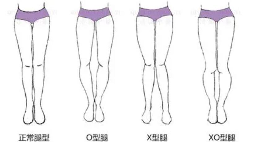 O型腿.jpg