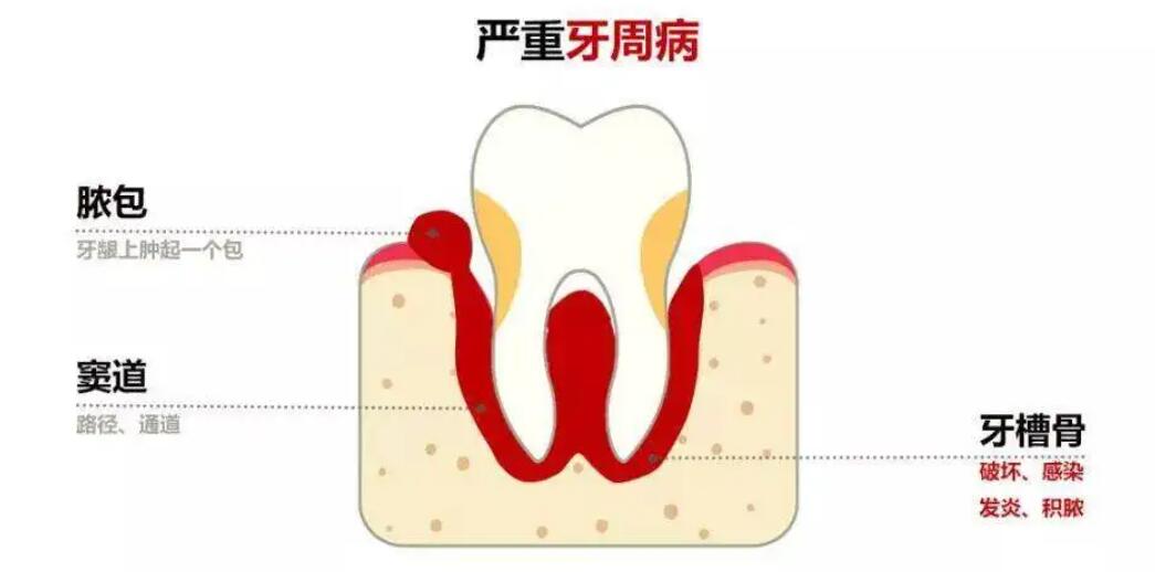 牙龈肿痛有脓包怎么办？是什么原因引起的？怎么才能消除？