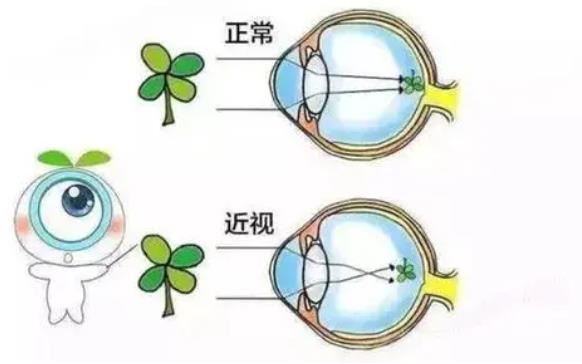 近视眼动漫011.jpg
