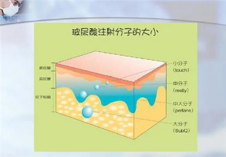 注射玻尿酸去除川字纹时需要注意哪些