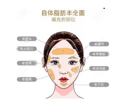 使用自体脂肪填充有哪些风险?
