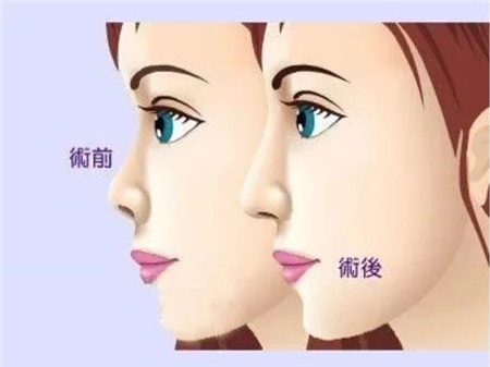 影响大蒜鼻整形价格的因素有哪些