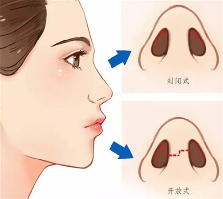 有什么缩小鼻翼的方法