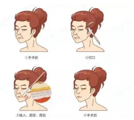 伍航利医生做拉皮怎么样?做完脸前后差别真不是一般的大