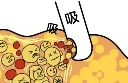 手臂吸脂的好处是什么，有什么副作用
