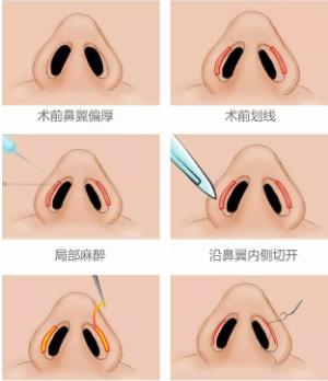 鼻翼外切除术和鼻翼内切除术哪个更好?