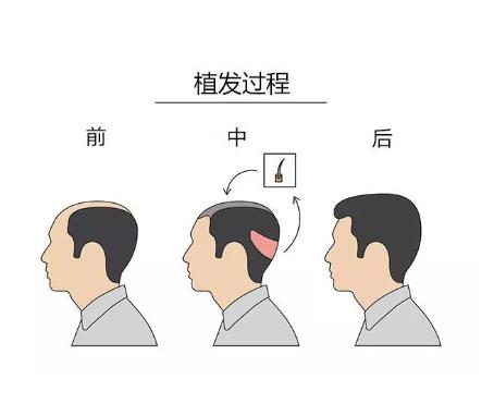 毛发移植前需要剃光头吗