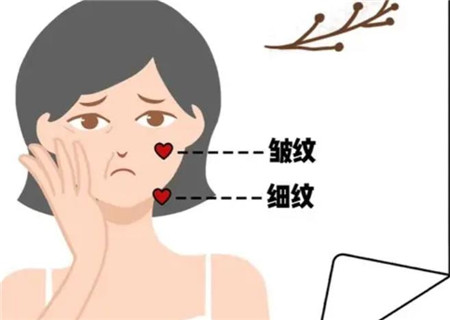 间断悬吊除皱术的特点及效果