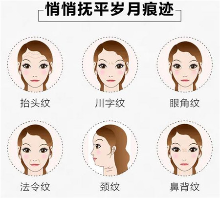 手术可以去除哪些皱纹?