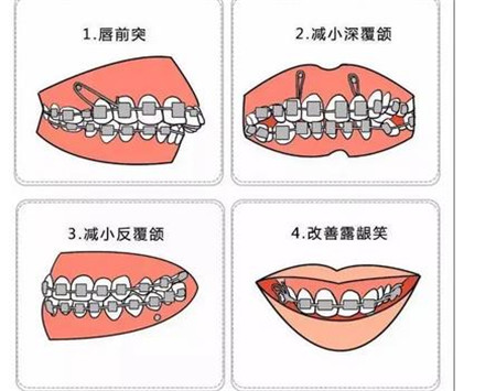 沈阳全好口腔正畸怎么样?真实案例分享！看我好牙齿的修炼秘籍！