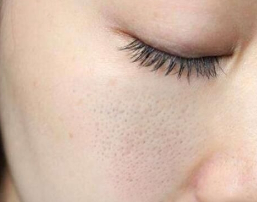 如何修复面部毛孔粗大？