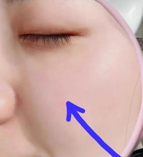 收缩毛孔的佳方法：细腻肌肤重拾自信