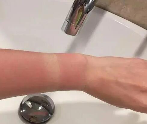 晒后修护攻略：从轻度到重度，全方位拯救你的晒伤肌肤