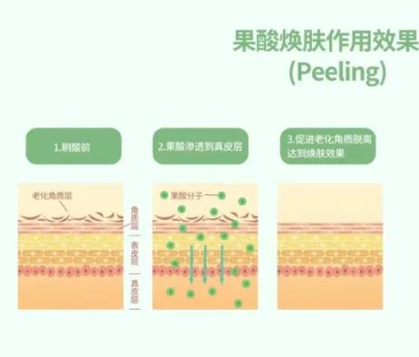 果酸换肤的优点借价格影响因素