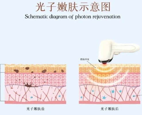 做光子嫩肤会导致皮肤变薄吗