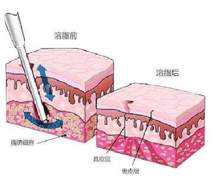 溶脂减肥有副作用吗?吸脂术与溶脂术有什么区别