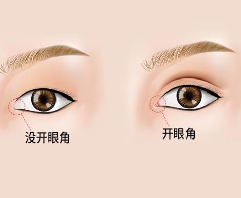 影响开眼角价格的因素有哪些?