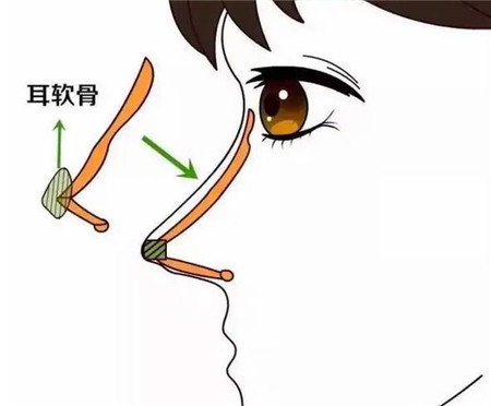 适合做隆鼻手术的鼻子有哪些?