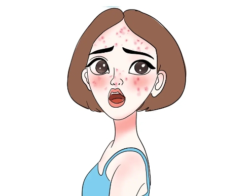 什么是激光祛痘印后反黑?如何处理