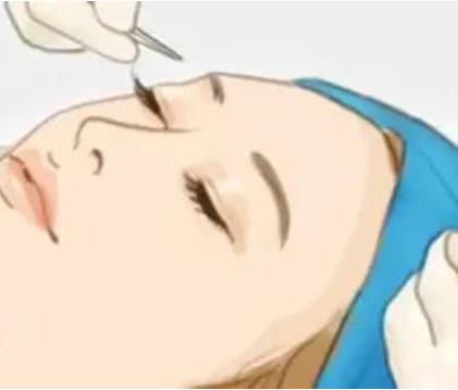 多大年龄适合开眼角