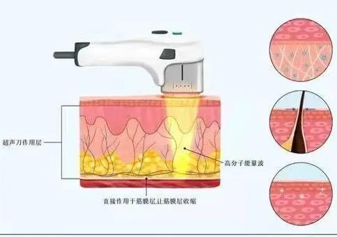 超声刀有哪些优点?会伤害皮肤吗