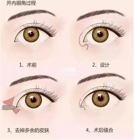 开眼角手术后的恢复时间以及怎么护理