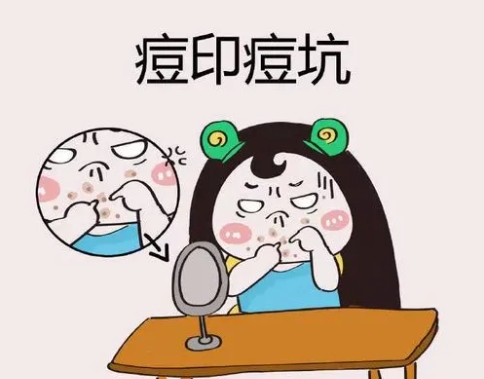 激光祛痘的原理是什么?会变黑吗