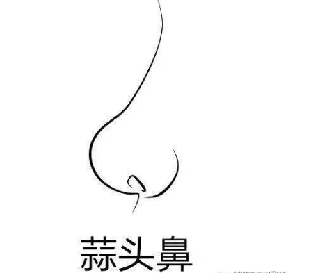 大蒜鼻整形术后恢复需要多长时间