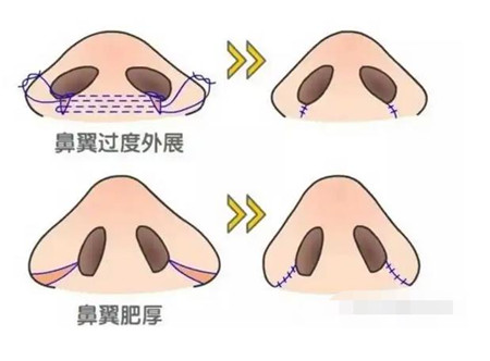 鼻翼缩小术有哪些后遗症?如何避免