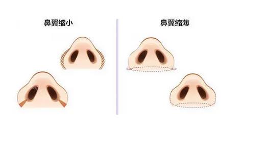 鼻翼缩小术效果怎么样?哪些人适合