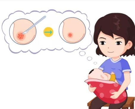 缩小乳晕大小的手术方法有哪些