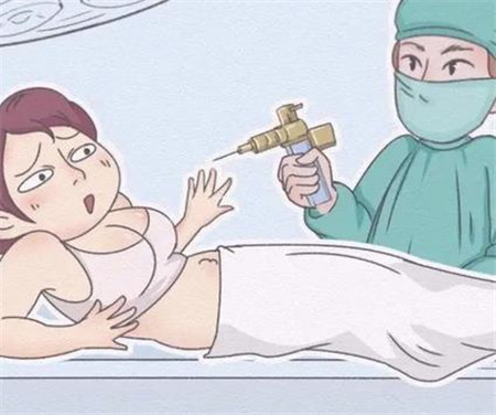 深蓝射频溶脂效果如何，有哪些优势