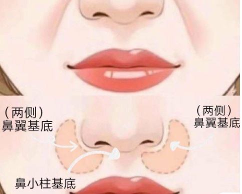 有哪些方法可以改良鼻基底凹陷?