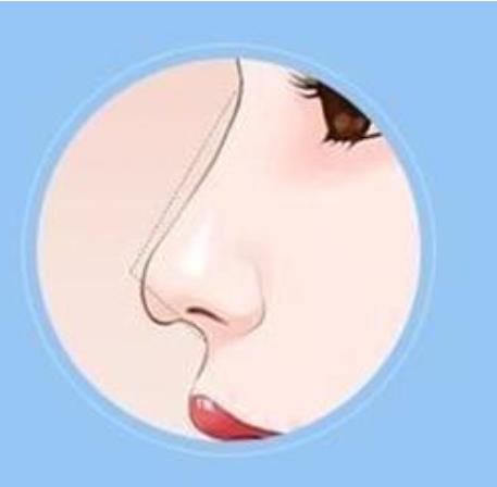 蒜头鼻整形后需要多长时间才能恢复