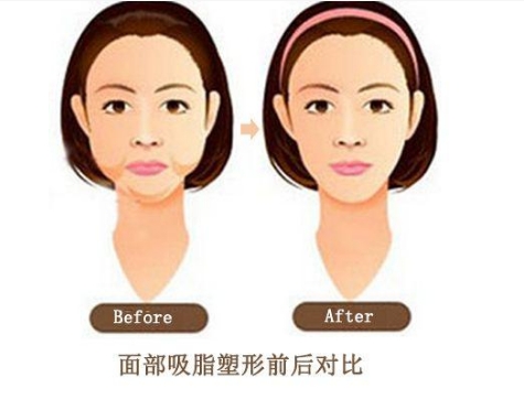 面部吸脂5.jpg