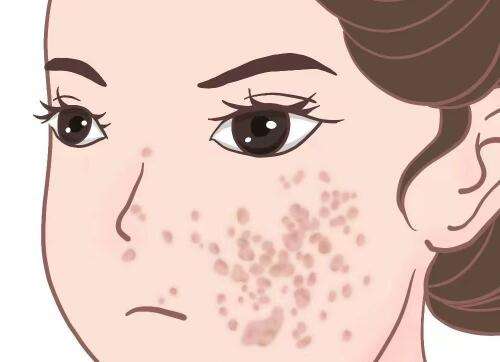 哈尔滨瑞丽祛斑好吗？真人案例，术后护理注意事项曝光