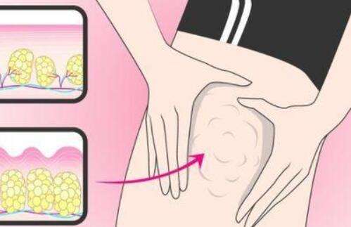 聚能吸脂价格是多少？严选吸脂费用标准，附注意事项一览