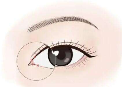 开眼角手术一般需要多少钱？了解费用标准和注意事项分享