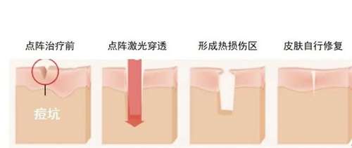 aopt超光子嫩肤和m22光子嫩肤区别有哪些？会保持多久？